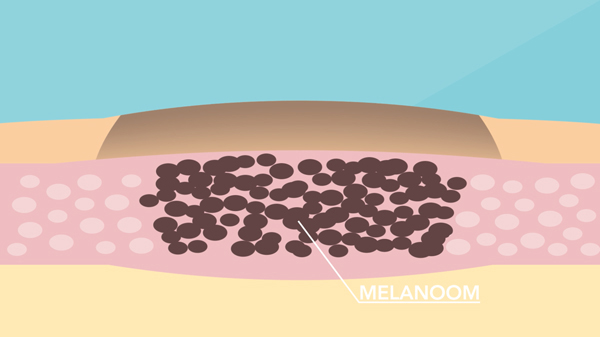 Animatie melanoom Medicijn in Beeld